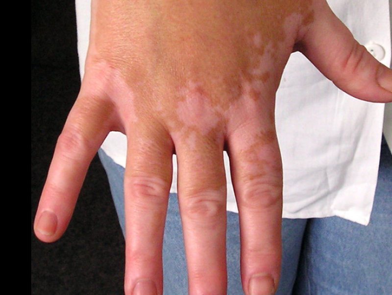 “Na mijn coronaprikken ontplofte vitiligo écht“
