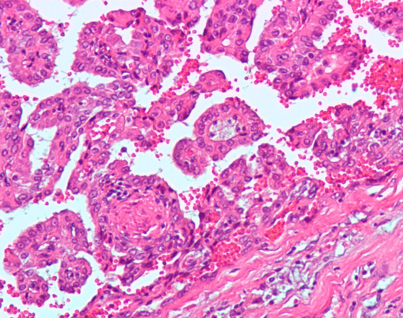Ozempic en soortgelijke medicijnen voor gewichtsverlies kunnen risico op nierkanker verhogen: verder onderzoek nodig