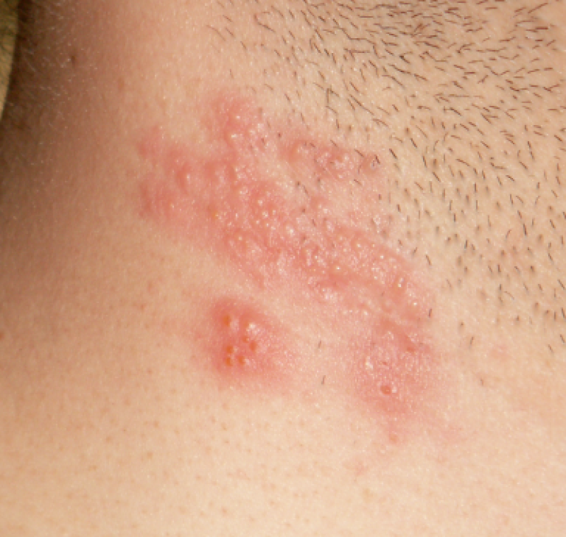 Studie: meer kans op gordelroos na mRNA-boostervaccin tegen Covid-19
