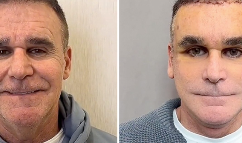 🎥 Plastisch chirurg gaat viraal nadat vijftigers eruitzien als Joker-lookalikes