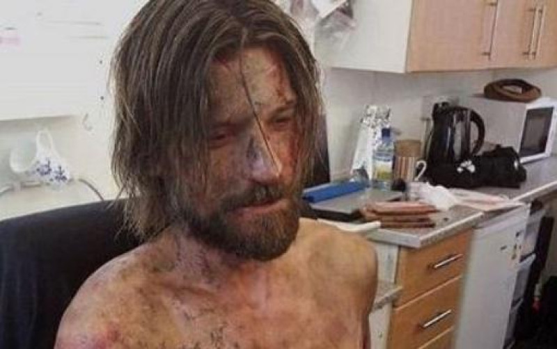 'Jamie Lannister' deelt wel erg akelige foto van zijn arm (foto)