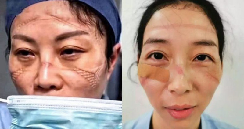 Chinese verpleegsters tonen wat 10 uur dragen van mondkapje met hun gezicht doet (foto's)