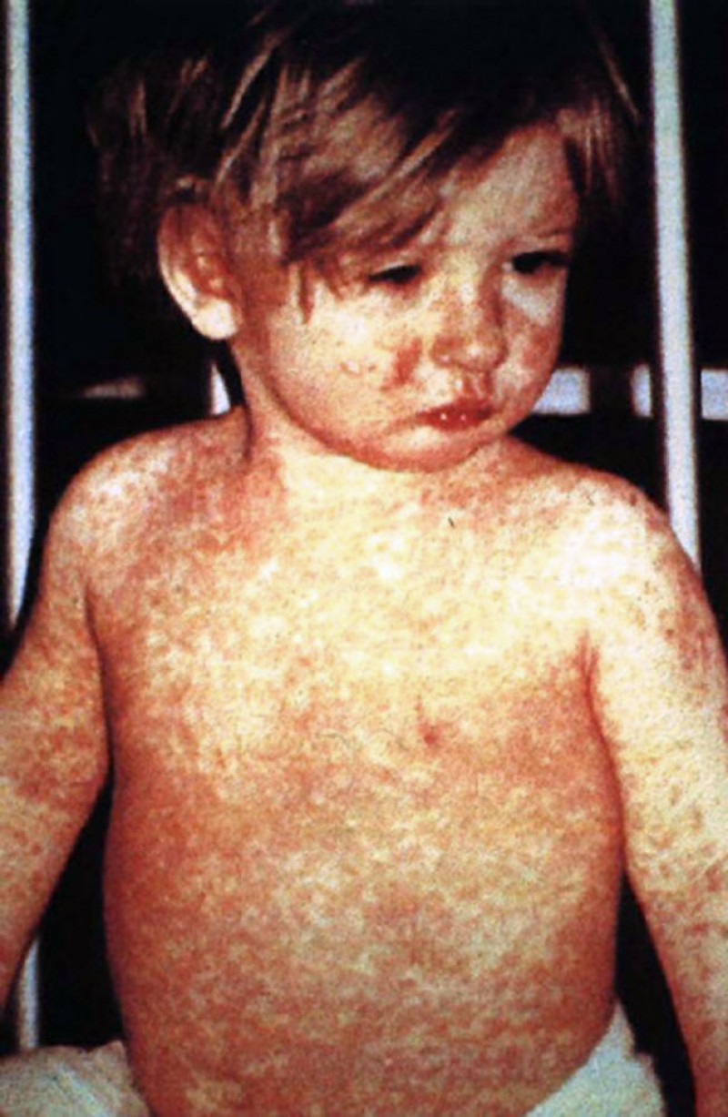 GEMS waarschuwde in juli al voor terugkerende coronaboemerang bij vaccinatie mazelen en kinkhoest