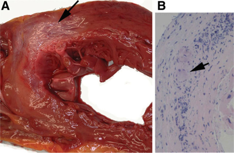 Hart van 2 overleden tieners met myocarditis na coronavaccins vertoont vreemde kenmerken