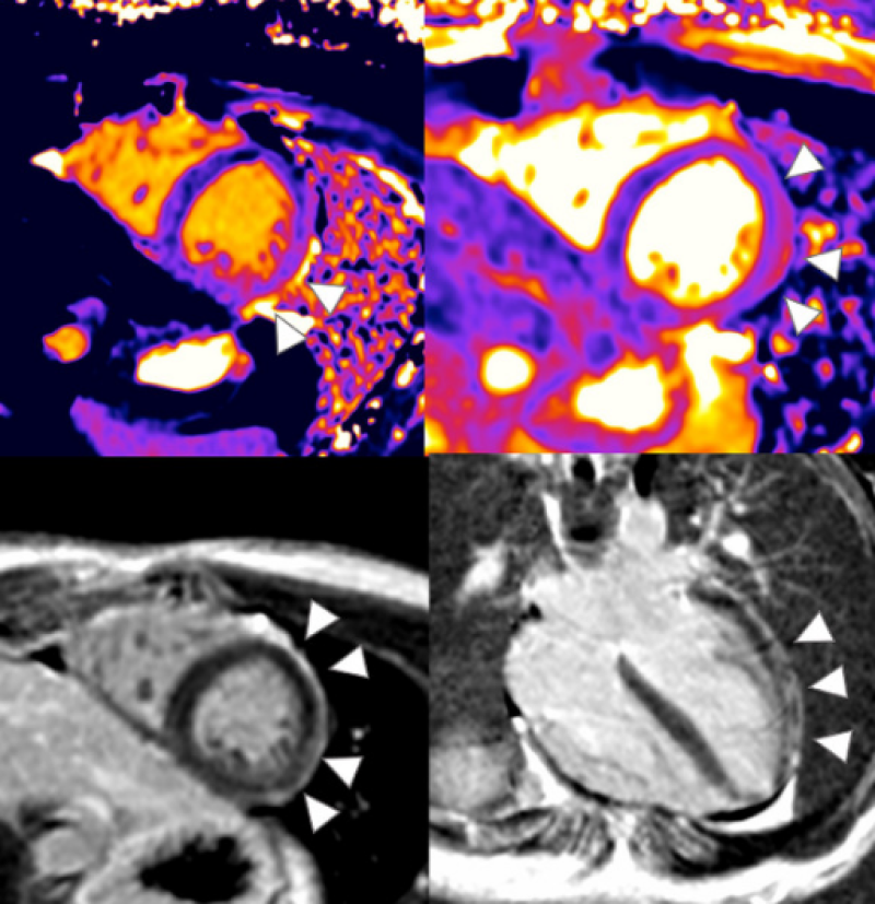 Milde vorm van myocarditis na coronavaccin geeft toch permanent littekenweefsel op hart