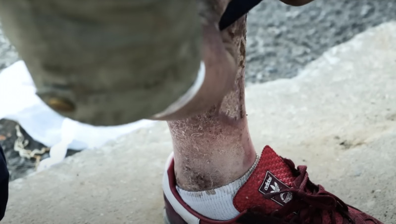 Nieuwe Amerikaanse drug die huid doet rotten in opmars (video’s)